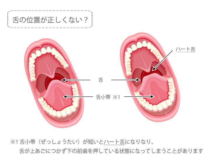 舌の位置とハート舌の関係解説イメージ